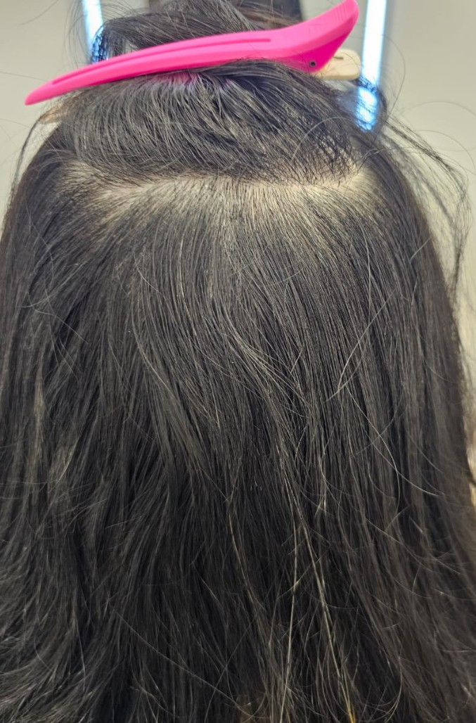 Alopecia Areata after treatment