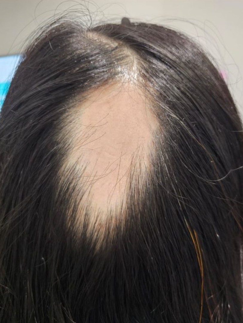 Alopecia Areata before treatment