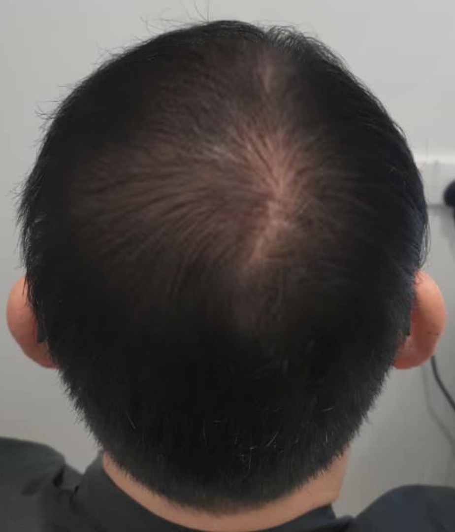 Androgenetic Hair Loss after treatment
