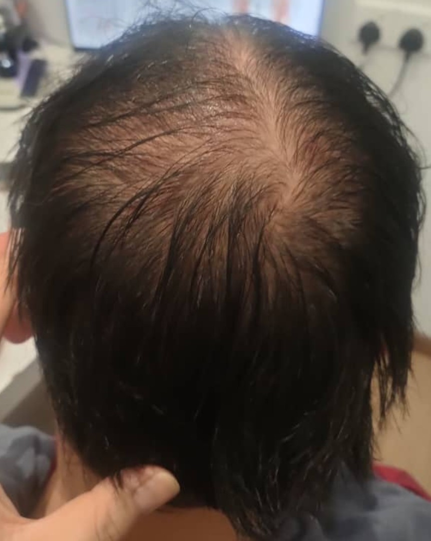 Androgenetic Hair Loss before treatment
