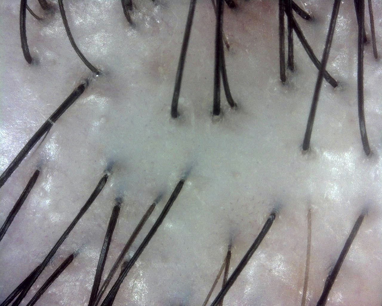 Dandruff after treatment