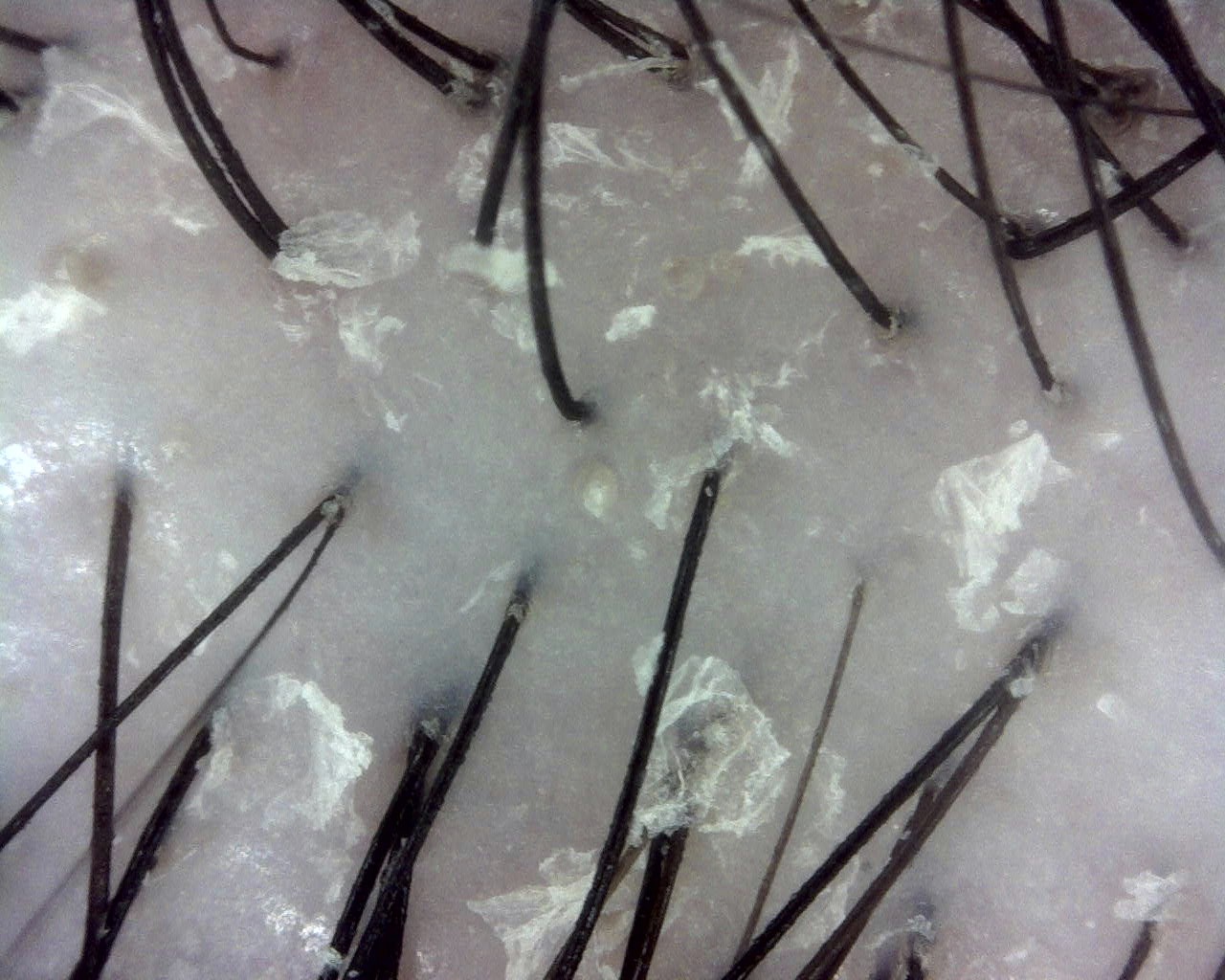 Dandruff before treatment