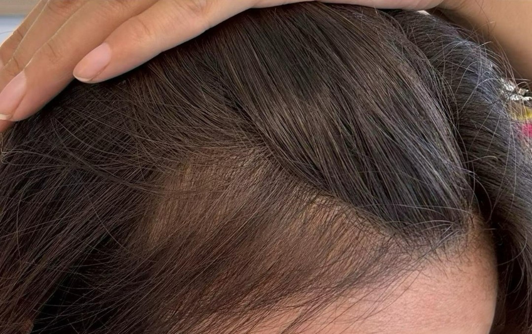 Female Hair Loss after treatment