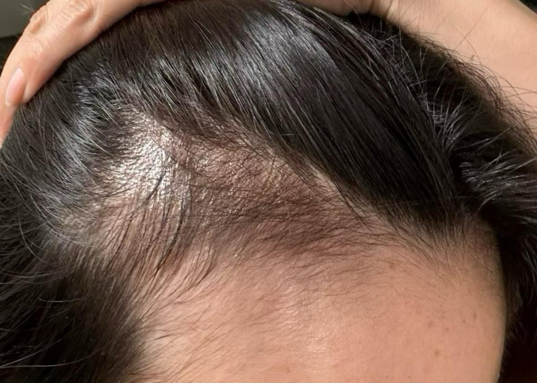 Female Hair Loss before treatment