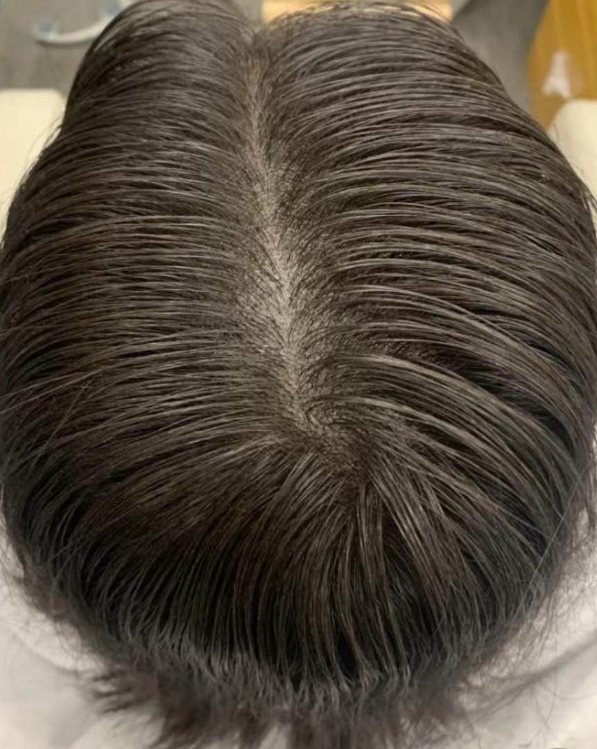 Menopause Hair Loss after treatment