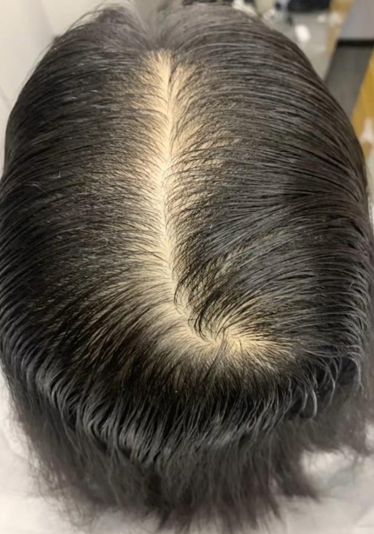 Menopause Hair Loss before treatment