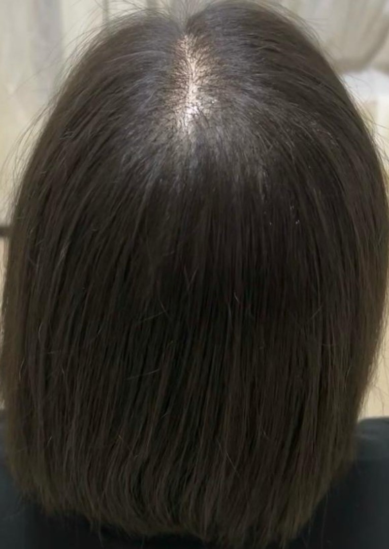 Post-Natal Hair Loss after treatment
