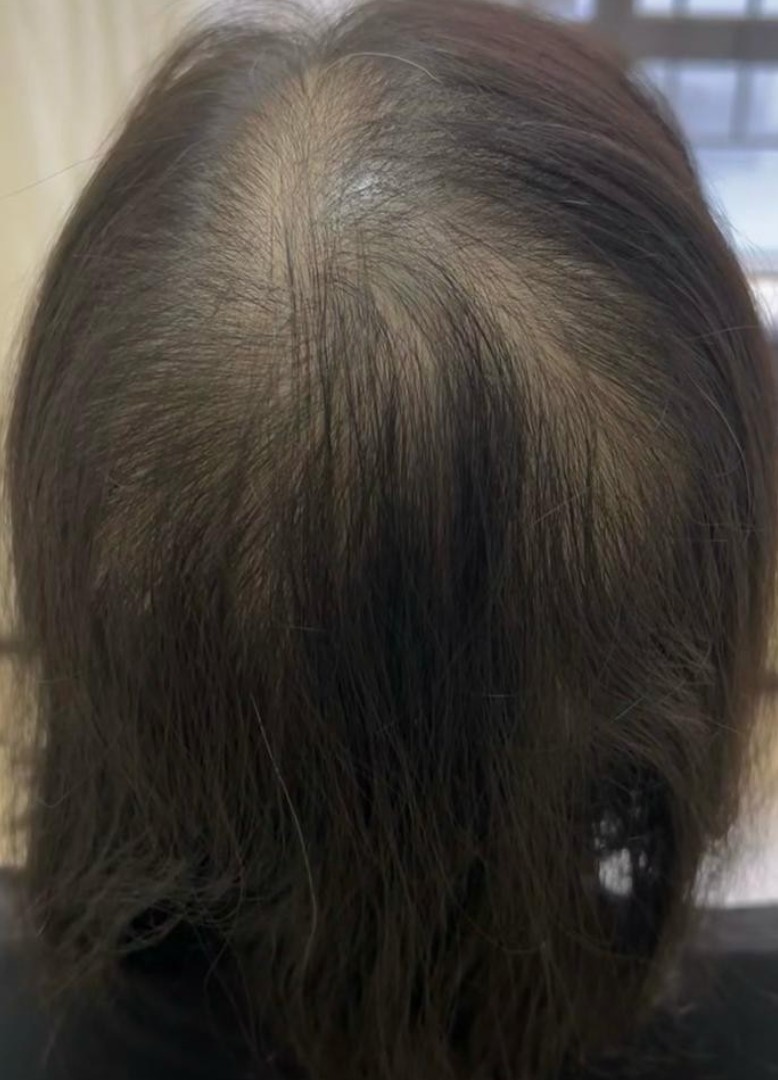 Post-Natal Hair Loss before treatment