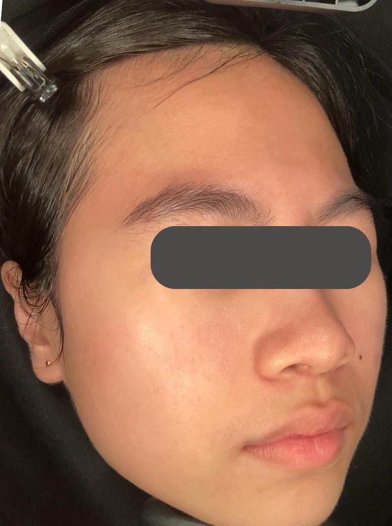 Anti Acne after treatment