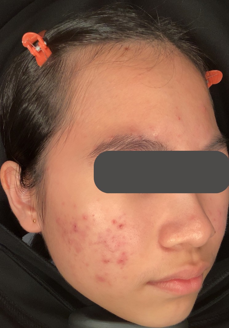 Anti Acne before treatment