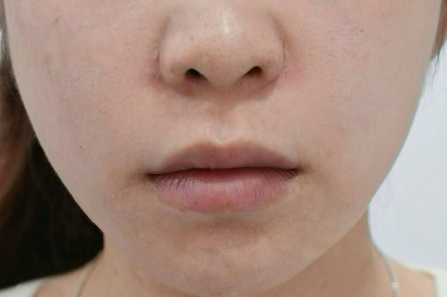 Anti Aging after treatment