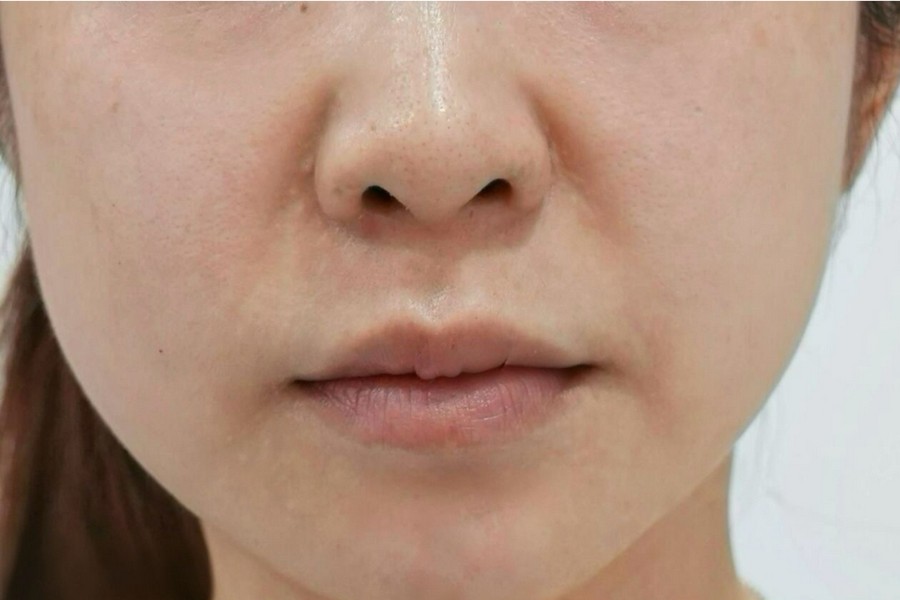 Anti Aging before treatment