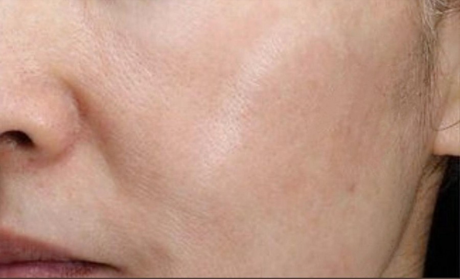 Anti Pigmentation after treatment