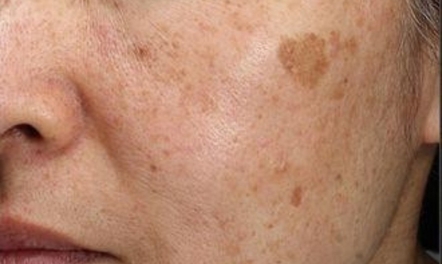 Anti Pigmentation before treatment