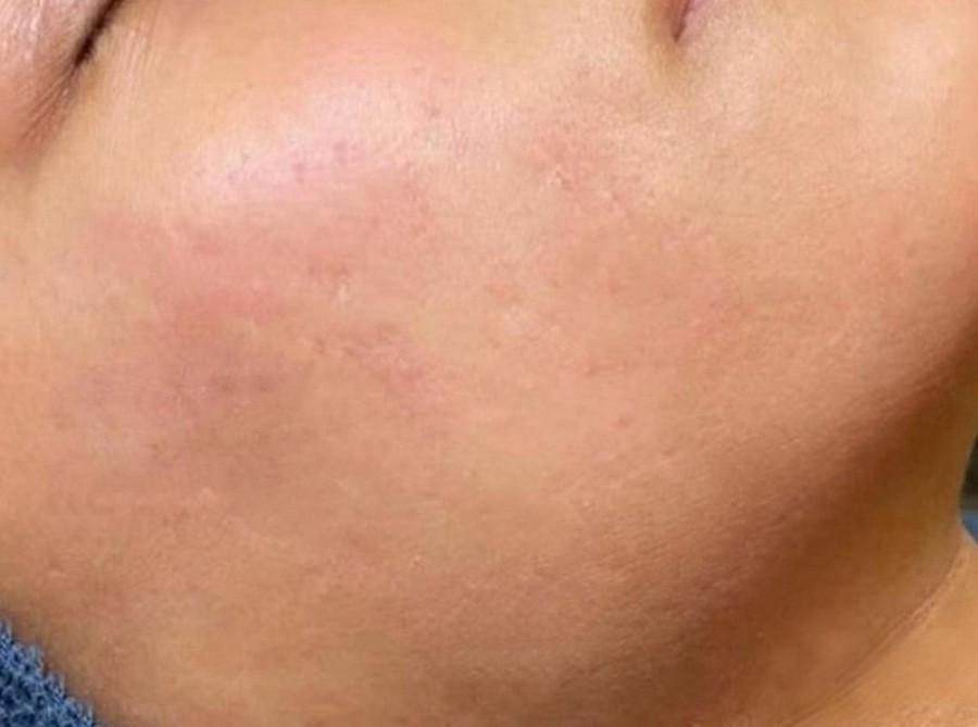 Anti Scars after treatment