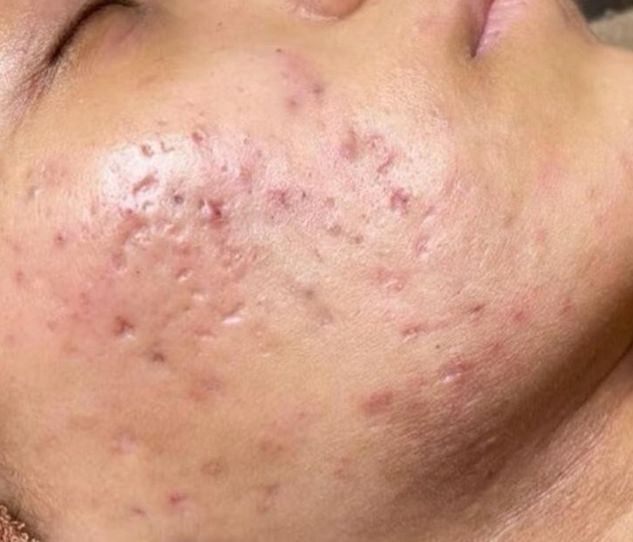 Anti Scars before treatment