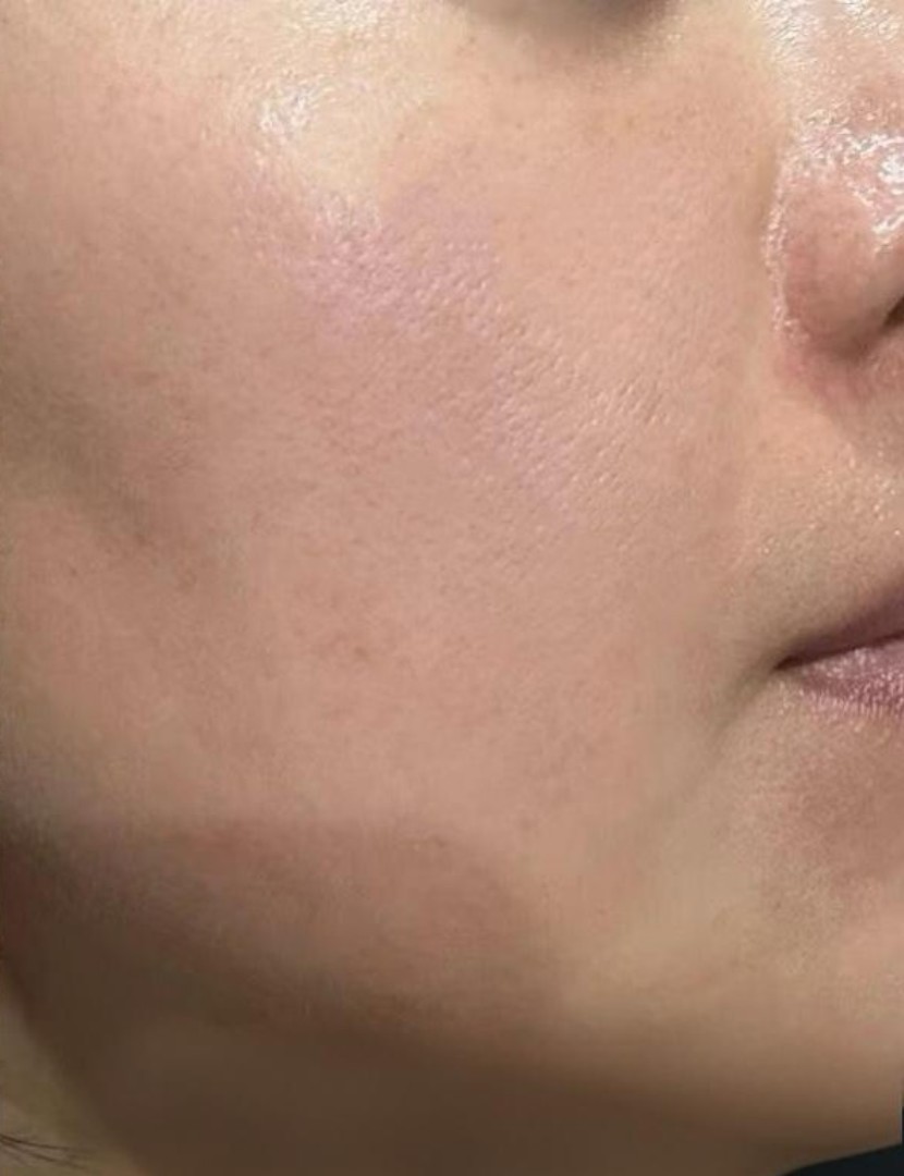 Hydro after treatment