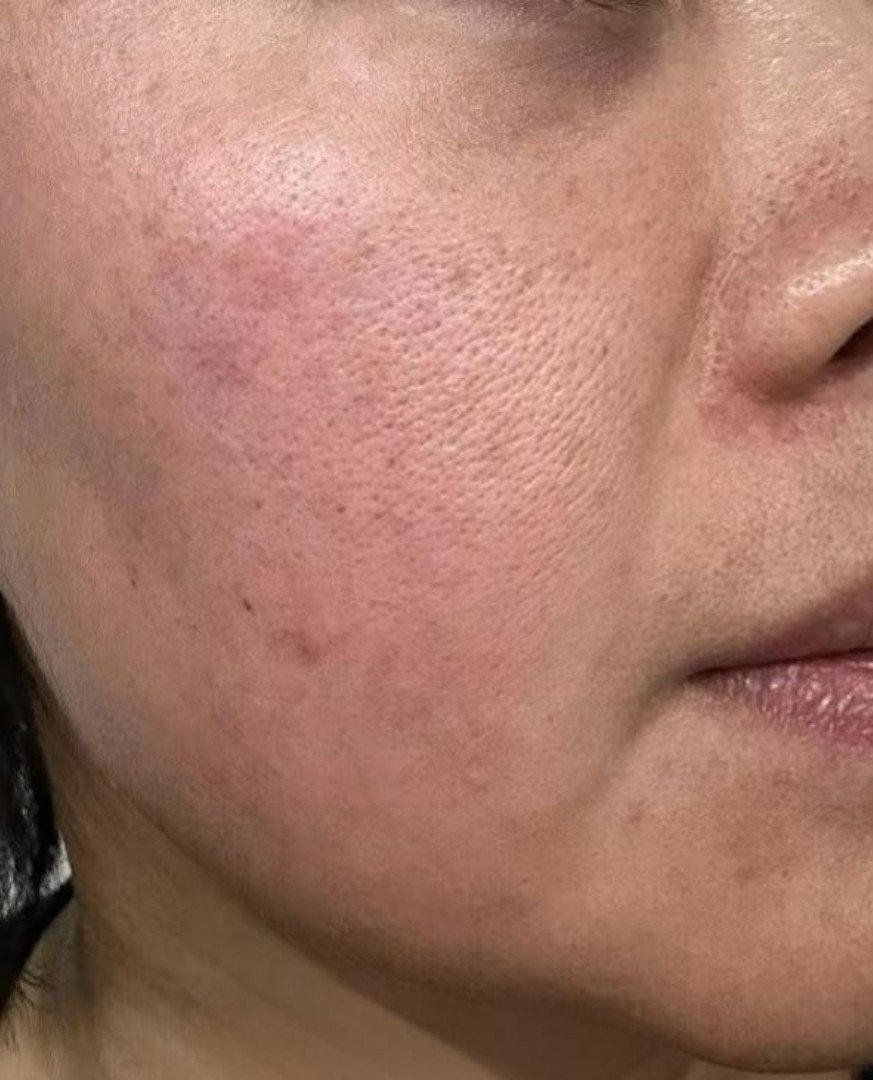 Hydro before treatment